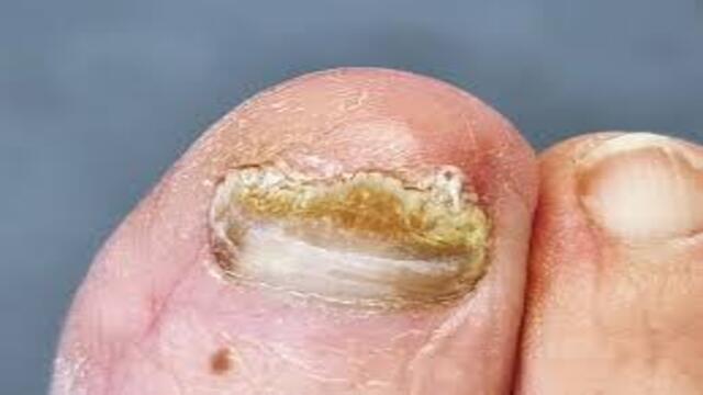 Obat untuk Mengatasi Infeksi Jamur